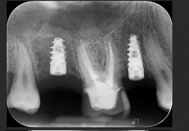 Implanturi dentare premolar