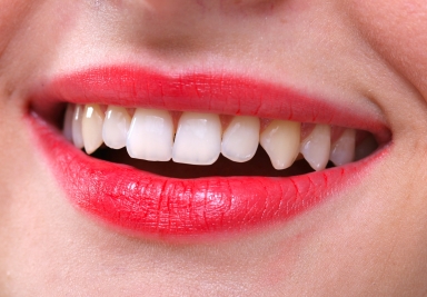 5 idei false despre implanturile dentare