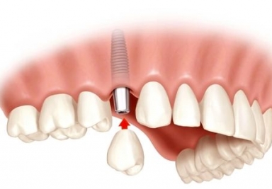 Ce este un implant dentars