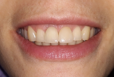 implant dentar Megagen Anyridge