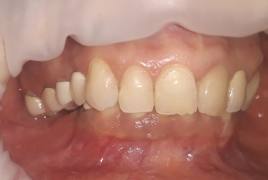 Fatete si coroane ceramice pe dinti si implanturi  Vezi imaginea