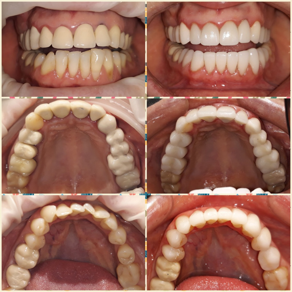 Aspectul arcadelor dentare inainte si dupa tratament