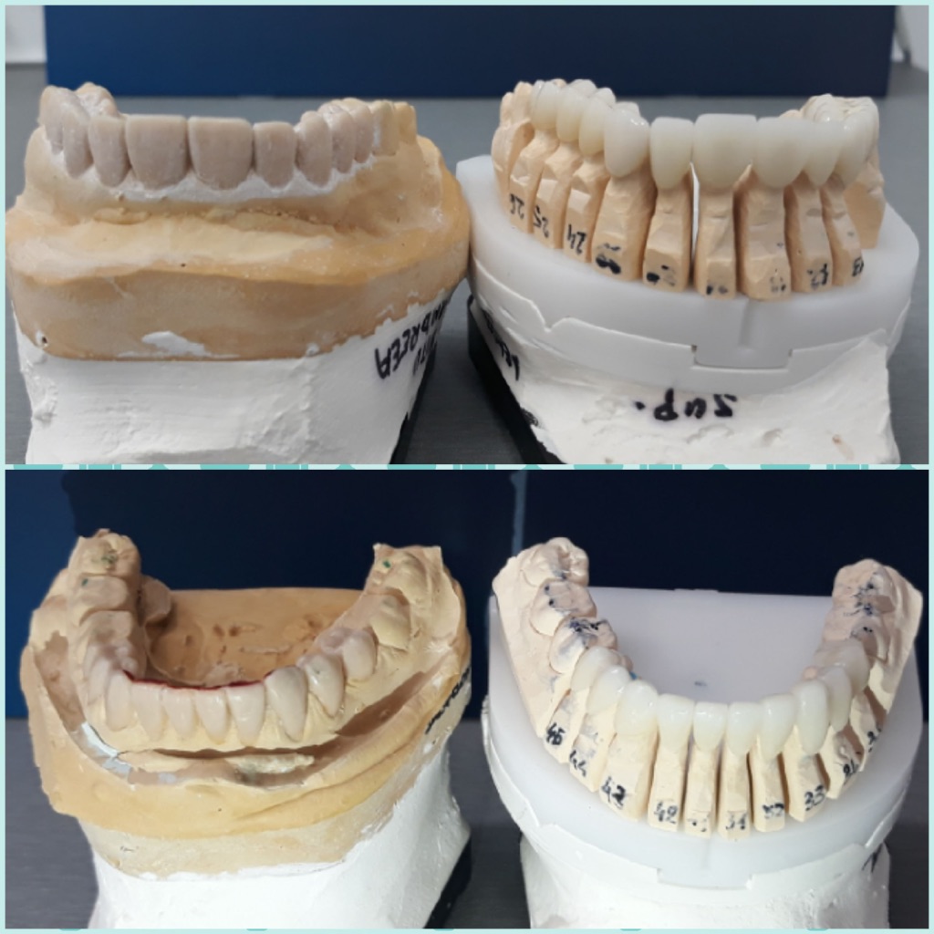 Comparatie intre wax-up si coroanele finale