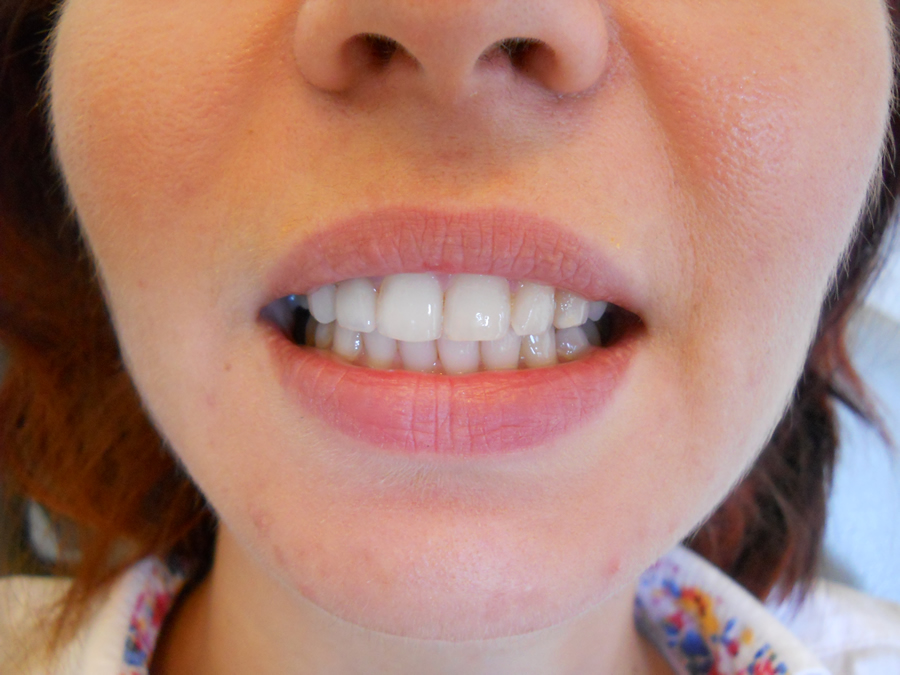 Coroana integral ceramica pe incisiv