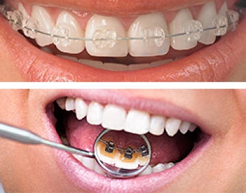 Aparate Dentare – Ortodontie
