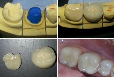 implant dentar