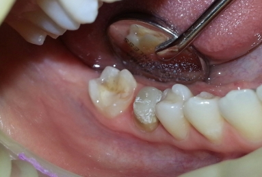 implant dentar