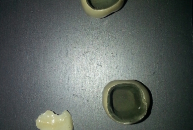 implant dentar