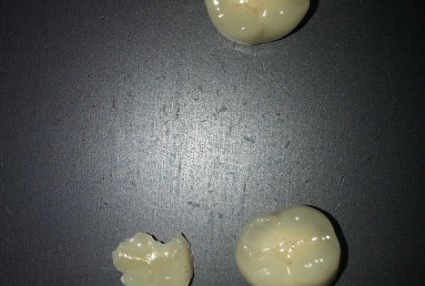 implant dentar