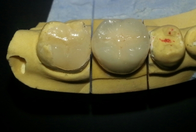 implant dentar