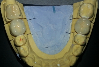 implant dentar