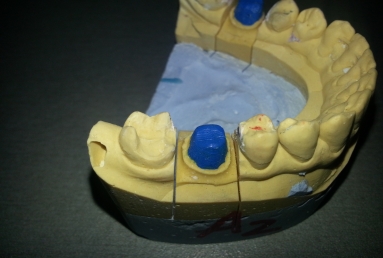 implant dentar