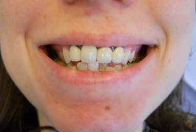 coroane ceramice caz clinic