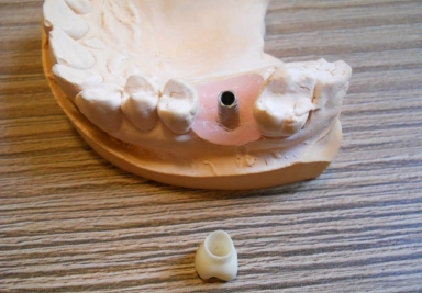 Coroana ceramica pe zirconiu pe implant