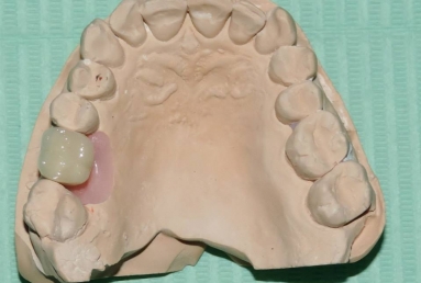 implant coroana dentara