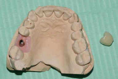 implant coroana dentara