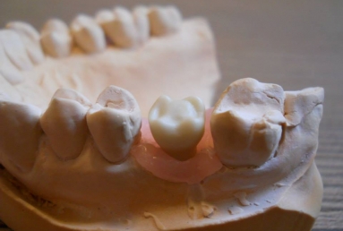 implant coroana dentara