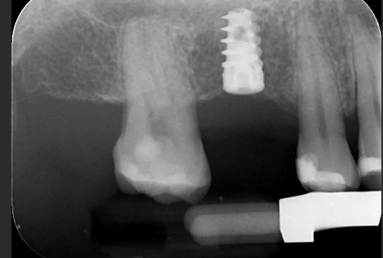 implant coroana dentara