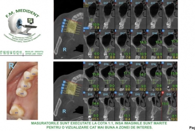 implant coroana dentara