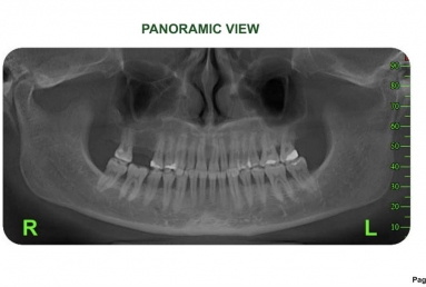 implant coroana dentara