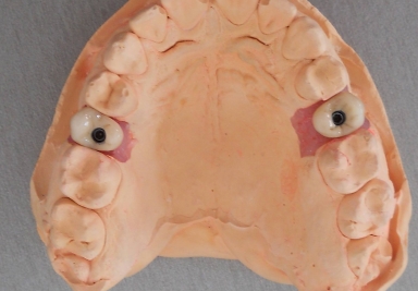 Implanturi premolari