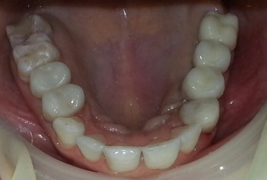 implant dentar