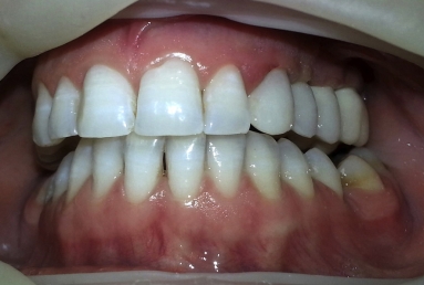 implant dentar