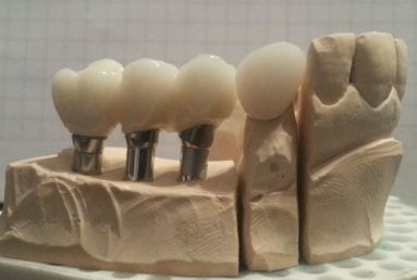 implant dentar