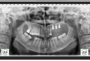 implant dentar