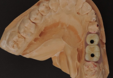 Implanturi mandibulare si coroane pe implant