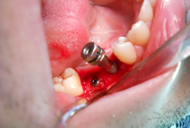 implant dentar