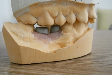 implant dentar