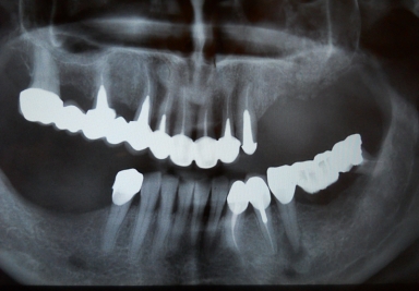 Sinus lifting extern