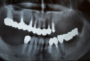 sinus lifting
