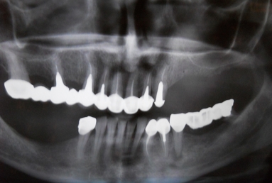sinus lifting