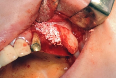 sinus lifting