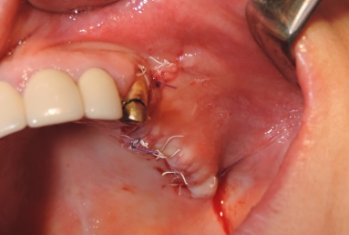 sinus lifting