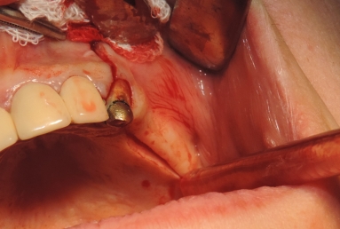 sinus lifting