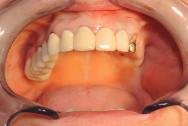 sinus lifting