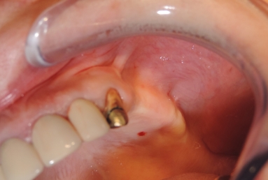 sinus lifting