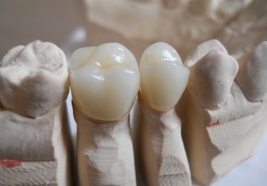 Coroane ceramice premolar