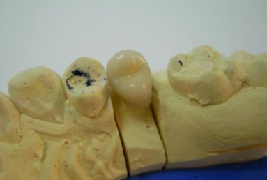 coroana ceramica