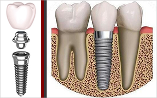 Implant Dentar