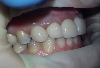 implant incisiv si coroana ceramica