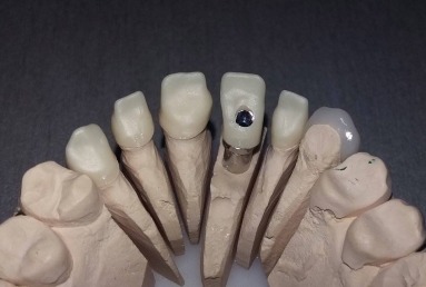 implant incisiv si coroana ceramica