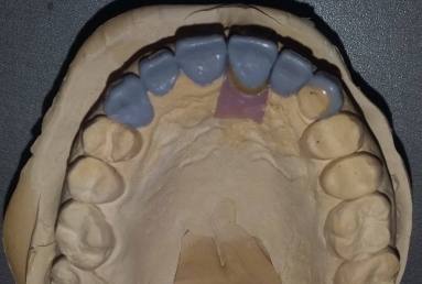 implant incisiv si coroana ceramica