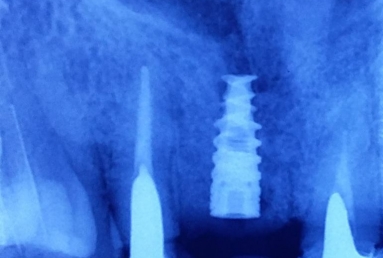 implant incisiv si coroana ceramica