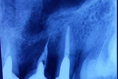 implant incisiv si coroana ceramica