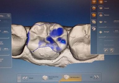 Coroane si inlay-uri prin tehnologia CAD CAM