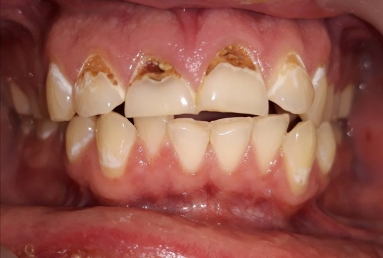 carii incisivi - demineralizare smalt dentar